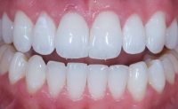 Відбілювання зубів: Відновлення блиску і самовпевненості