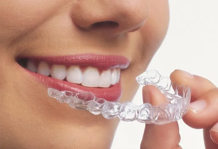 Invisalign Aligners