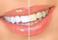 Як проводиться відбілювання зубів - чи варто відбілювати зуби