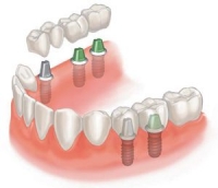 Как выбрать клинику для протезирования зубов?